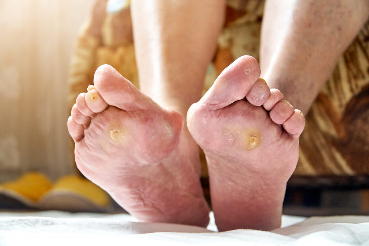 Ulcers — River Podiatry I The Best Foot and Ankle Care in NY/NJ