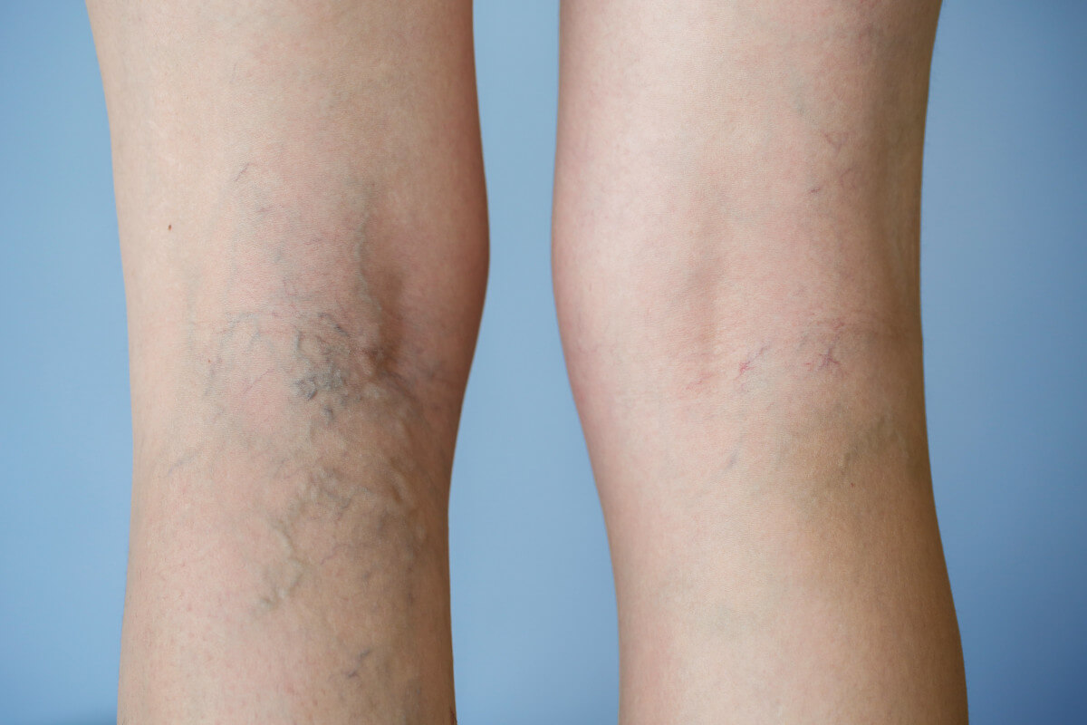 What Causes Varicose Veins And How to Treat Them