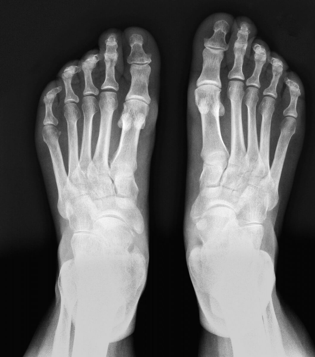 Ankle Fracture  Texas Children's